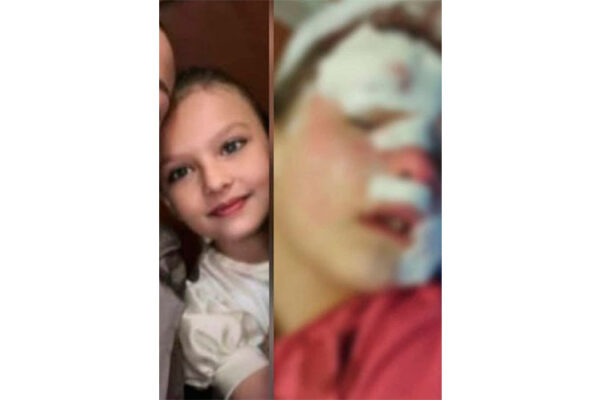 У Смілі собака покусав 9-річну дівчинку